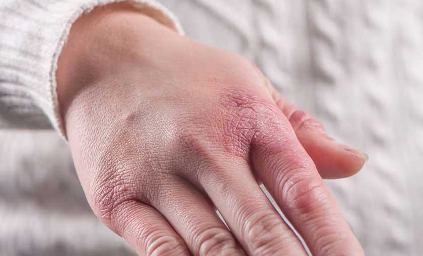 Ayurveda Skin & Derma Care (Psoriasis & Eczema Management Program)